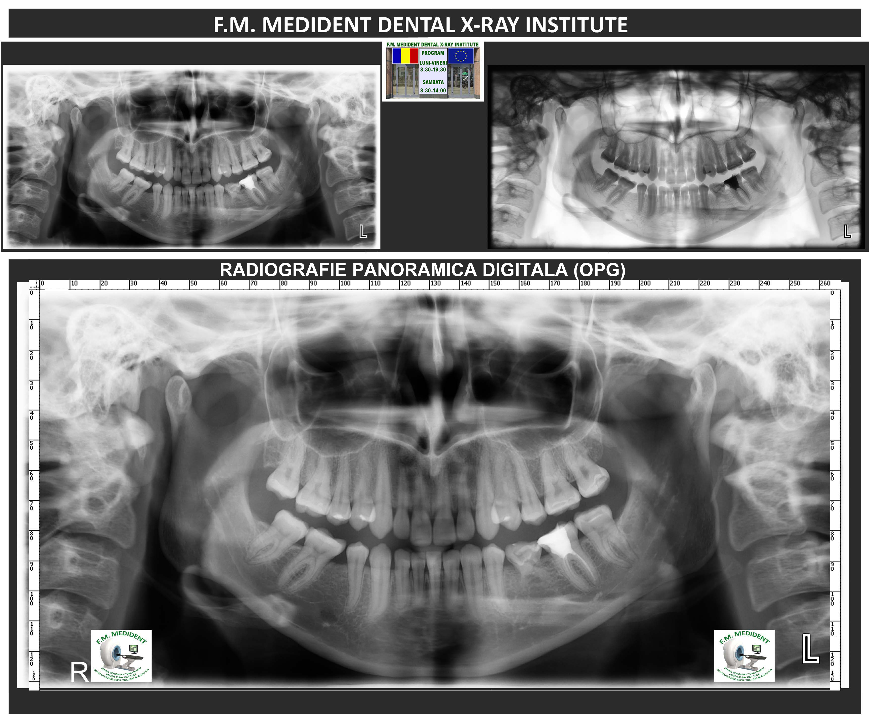 Radiografia digitală panoramică - cu pipă
